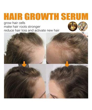 2023 New Allurium Hair Growth Serum for Black Women - Set of 3 Bottles | Anti Hair Loss, Nourishing & Repairing Formula for Fast, Natural Growth - Buy Online on GoSupps.com