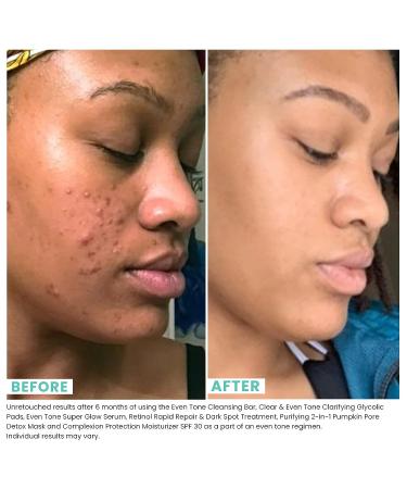 Urban Skin Rx Clear & Even Tone Glycolic Pads - Exfoliating Formula with Salicylic Acid for Blemish-Free, Balanced Skin | 30 Count - Buy Online on GoSupps.com