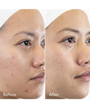 REJURAN Advanced Scar Treatment Bundle - Clinical Grade Scar Gel & Intensive Mask - 1.34oz & 3.5oz - Buy Online on GoSupps.com
