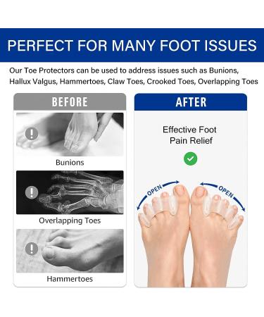 Large Toe Separators & Spacers for Women/Men - Bunion & Toe Corrector for Bunions, Hammertoes, Hallux Valgus - 1 Pair, White - Buy Online on GoSupps.com