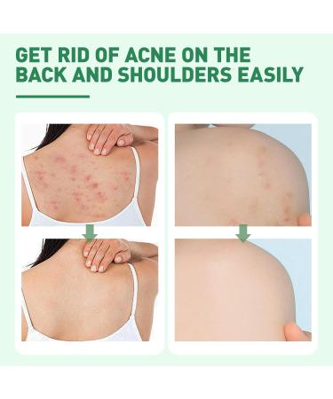 Back Acne Treatment Spray With Herbal Formula 2% Salicylic Acid & Tea Tree Oil - Body Acne Solution 120ml 1PCS - Buy Online on GoSupps.com
