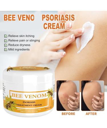 Cvreoz Bee Venom Psoriasis Cream - Bee Venom Psoriasis Cream New Zealand Bee Venom Cream Fast-Acting Relief Bee Venom Cream Psoriasis Cream Soothing Psoriasis Cream 30g (1) - Buy Online on GoSupps.com