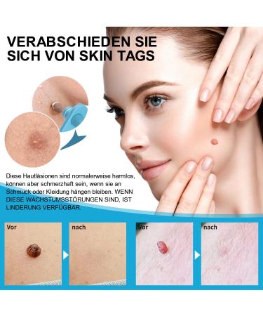 Buy Wuiil Warzenn Stem Wart Remover Kit - 3-in-1 Skin Day Patches for Face Neck & Body | Effective Fibroma & Wart Removal | Shop Internationally - Buy Online on GoSupps.com