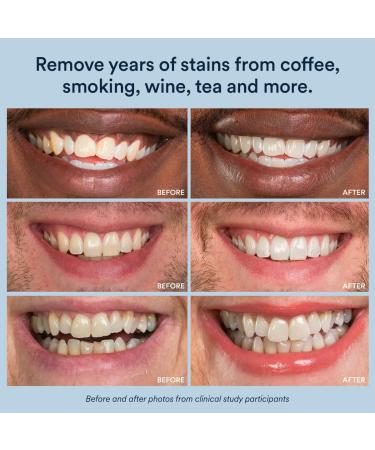 Auraglow 35% Carbamide Peroxide Teeth Whitening Gel Refill Pack - 30 Treatments - Buy Online on GoSupps.com