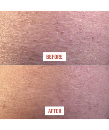 First Aid Beauty KP Bump Eraser Scrub 2oz - Exfoliant for Keratosis Pilaris with 10% AHA - Buy Online on GoSupps.com