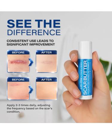 KELODA Keloid Scar Care Butter Stick - Surgical Scars & Keloids Removal Balm with Cocoa & Shea Butter - For Stretch Marks, Acne, Piercings | Coconut & Jojoba Oils - Effective Anti-Scar Treatment - Buy Online on GoSupps.com