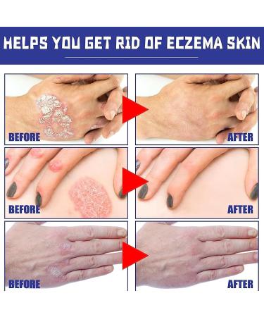 SHEDIAO South Moon Psoriasis Relief Spray - Herbal Treatment for Skin Plaque Psoriasis (5PCS) - Buy Online on GoSupps.com