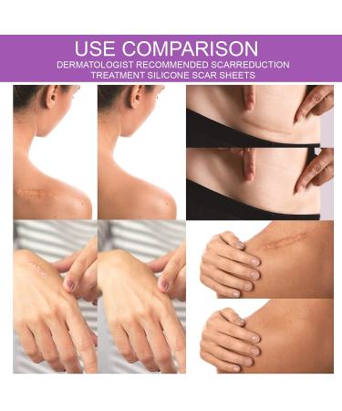Silicone Scar Removal Sheets (Pack of 4) - 5.9 x 1.6 - Body, Surgical, Burn, Acne & Keloid Treatment - 2 Month Supply - Buy Online on GoSupps.com