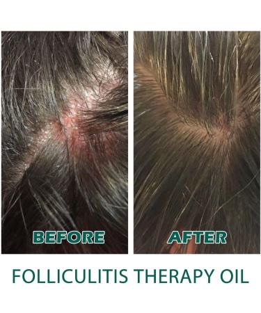 Scalp Folliculitis Treatment Oil Folliculitis Scalp Oil Nourishing Treatment for Split Ends and Dry Scalp for All Hair Types - Buy Online on GoSupps.com