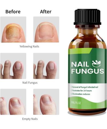 Extra Strength Toenail Fungus Treatment - 30ml | Effective Nail Fungus Solution for Thick Broken & Discolored Nails - Fast Shipping Internationally - Buy Online on GoSupps.com