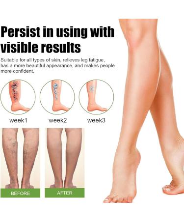 Varicose Veins Expert Spray - Effective Treatment for Legs Boost Blood Circulation & Relieve Tiredness | 1 Piece - Buy Online on GoSupps.com