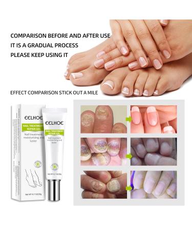 Yueci Hand & Foot Care Cream - Heal Cracked Nails & Toenails | Nail Repair Treatment (2PCs) - Buy Online on GoSupps.com