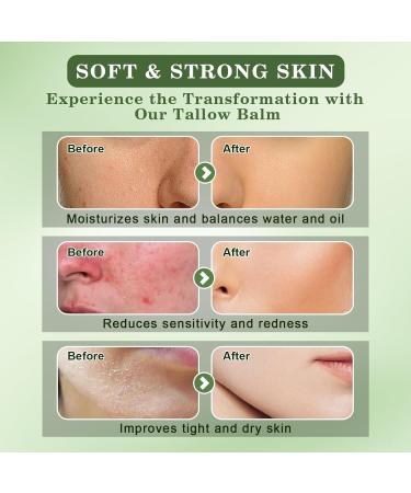 Beef Tallow and Honey Balm for Skin - All-Natural Moisturizer Hydrates and Nourishes the Skin Grass-Fed Beef Tallow & Honey Balm Blend Deeply Moisturizing for Face & Body Natural Skin Care Balm 2.0 oz - Buy Online on GoSupps.com