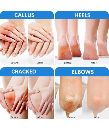 42% Urea Foot Cream Urea Cream 42 Percent for Feet Cracked Heel Repair Cream Foot Cream for Cracked Heels and Dry Skin Hard Skin Remover Foot Cream Urea Cream Soften Deep Moisturizing Foot Moisturiser - Buy Online on GoSupps.com
