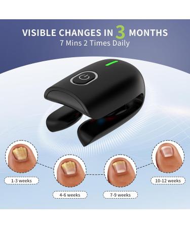 Effective Nail Fungus Light for Toenail & Fingernail Treatment | Restore Damaged & Discolored Nails - Buy Online on GoSupps.com