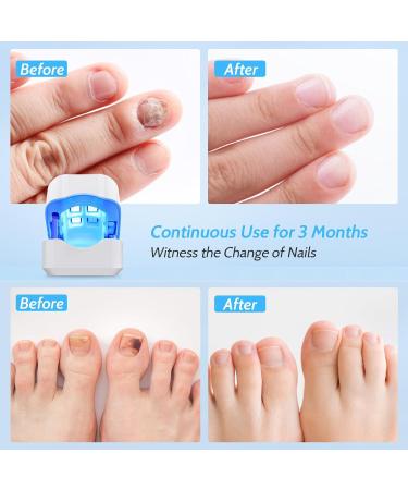 Best Nail Fungus Treatment Device | Rechargeable Cold Laser Therapy for Fingers & Toenails - Buy Online on GoSupps.com