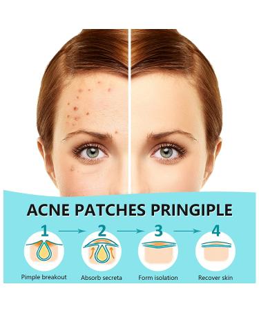 Hydrocolloid Acne Patches 180 Counts - Invisible Blemish Cover Stickers for Face - Acne Spot Treatment - Pimple Patch - Buy Online on GoSupps.com