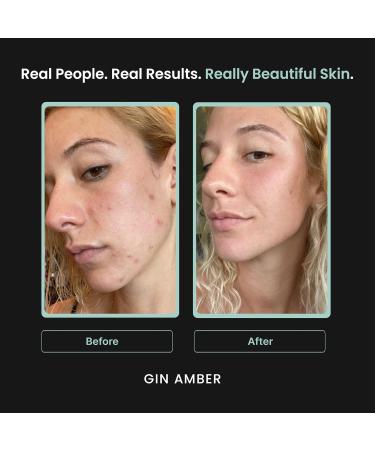 Microdermabrasion Derma Roller Face Tool 0.25mm Microneedling 192 Real Needles - Gin Amber Beauty - Buy Online on GoSupps.com