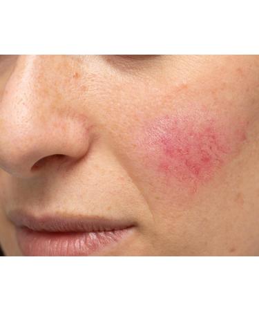 Organic Essential Oils for Rosacea Relief - 28-Day Dual Stage Treatment - Buy Online on GoSupps.com
