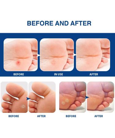 TXL Active Feet Corn Remover 30 Pack - Fast & Easy Toe Corn Removal with Cushioning Protection - One Step Corn Removers for Feet and Toes - Buy Online on GoSupps.com