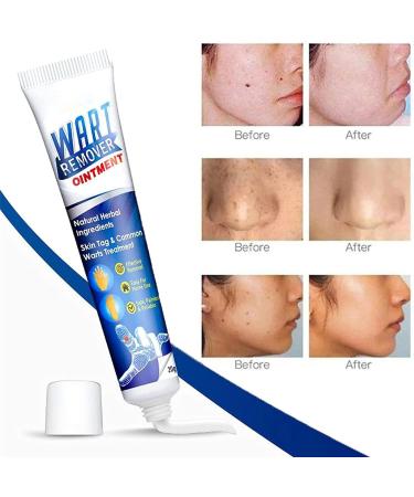 Wart Removal Body Warts Treatment Cream Foot Care Cream Skin Tag Remover Instant Blemish Removal Gel Body Treatment Ointment Without Leaving Scars and Refuse to Repeat (3Pcs) - Buy Online on GoSupps.com