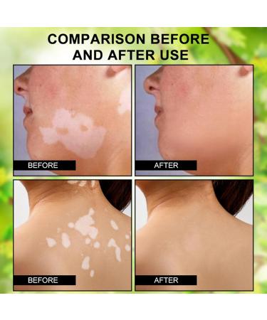 Crsetmyth Vitiligo Care Cream Skin Lightening and Repair Treatment 50ml - Buy Online on GoSupps.com