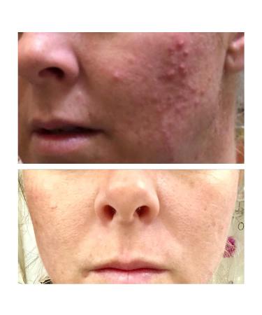 Glycolic Acid 20% Resurfacing Pads with Vitamins B5, C & E - 50 Peel Pads for Smooth Skin, Reduce Wrinkles - Buy Online on GoSupps.com