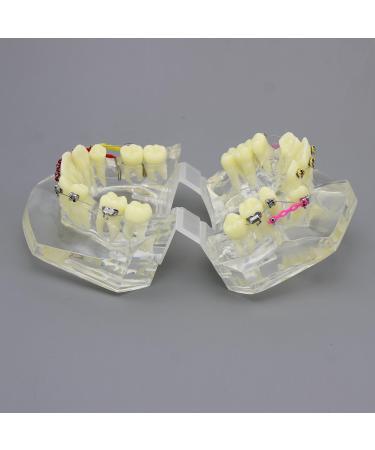 Shop Dental Malocclusion Orthodontic Treatment Model - Metal Brackets & Colorful Ties | M3005 - International Shipping Available - Buy Online on GoSupps.com