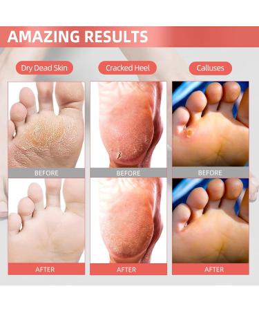 Soothing Peach Foot Peel Mask - 2 Pack for Dry, Cracked Feet - Exfoliating and Softening Formula for Baby Soft Feet - Callus Remover - Includes 2 Pairs - Buy Online on GoSupps.com