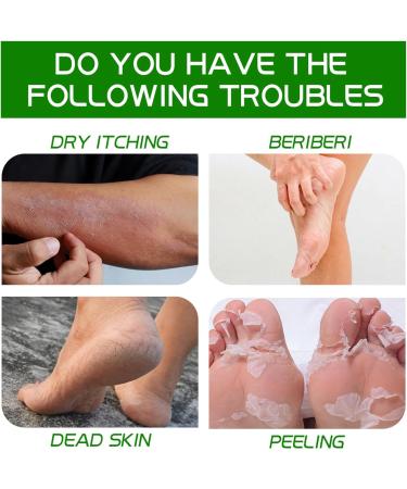 Urea Cream 40 Percent for Feet 40% Urea Cream for Cracked Heels and Dry Skin Aloe Vera Foot Cream with Tea Tree Oil Deep Moisturizing Callus Remover Nourishes Soften for Feet/Knees/Hands/Elbows - Buy Online on GoSupps.com