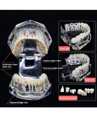 Buy Youya Transparent Dental Tooth Model for Dentists | Removable Pathological Teaching Model | International Shipping Available - Buy Online on GoSupps.com