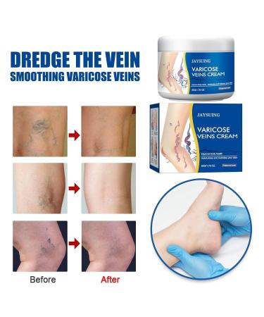 Leg varicose vein cream gentle soothing and moisturizing leg varicose vein and spider vein repair cream-2 boxes - Buy Online on GoSupps.com