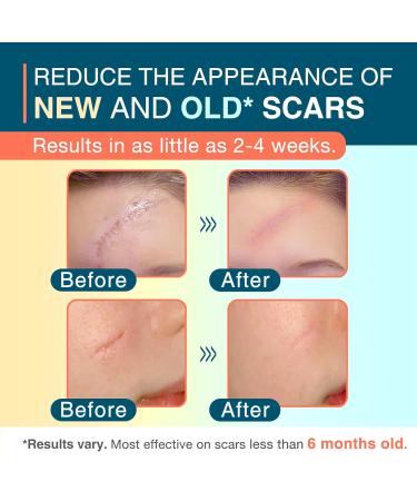 Silicone Scar Sheets 1.5 x 78 Roll - Reusable Medical Scar Tape for C-Section Keloid Stretch Marks & Surgical Scar Removal - Buy Online on GoSupps.com