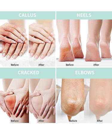 Urea Cream 40% - 250g Horn Skin Remover & Deep Moisture Lotion with Hyaluronic Acid Tea Tree & Aloe Vera for Feet Hands & Body - Buy Online on GoSupps.com