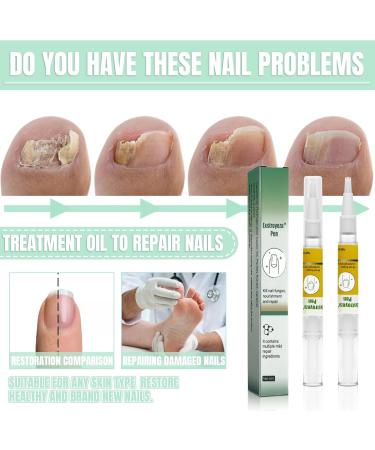 Buy Nail Care Pen Set | 2 Pieces Nail Hardener & Treatment for Healthy Nails - Fast & Effective Repair for Broken Nails & Fungal Infections - Buy Online on GoSupps.com