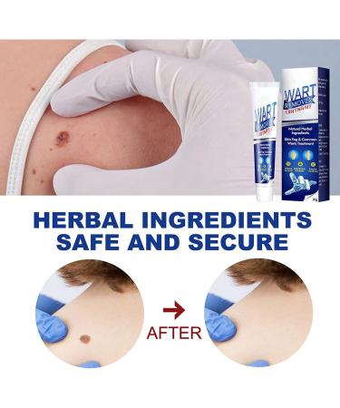 Wart Removal Body Warts Treatment Cream Foot Care Cream Skin Tag Remover Instant Blemish Removal Gel Body Treatment Ointment Without Leaving Scars and Refuse to Repeat (3Pcs) - Buy Online on GoSupps.com