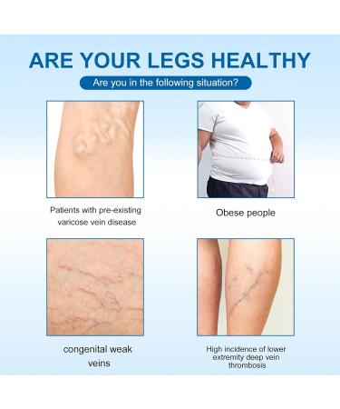 B ton de r paration des jambes pour varices b ton de peau pour jambes cr me pour liminer les veines d'araign e pour une meilleure circulation et un soulagement des jambes lourdes fatigu es | Non 1 - Buy Online on GoSupps.com