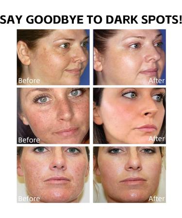 Dark Spot Correcting Serum Anti Ageing Face Serum with Niacinamide Hyaluronic Acid Serum Dark Spot Remover for Face Skincare Brightening Serum Reduce Age Spots Fine Lines Hyperpigmentation - Buy Online on GoSupps.com