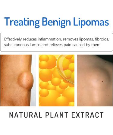 Lipoma Removal Cream 20g - Natural Treatment for Lipoma Care & Discomfort - Buy Online on GoSupps.com