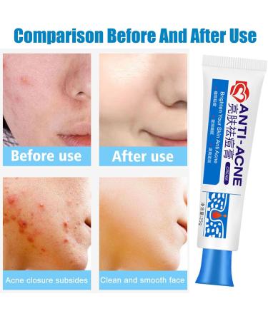  QEEROYO Anti-Acne Cream Spot-Treated Acne Treatment Facial Acne Cream Anti-Blemish Face Cream Moisturizes Skin Eliminates Blemishes and Redness for Men and Women 25g - Buy Online on GoSupps.com