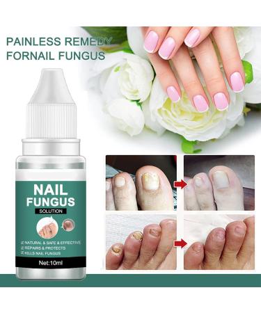 Fungal Nail Treatment for Toenail - Extra Strong Ingrown Toenail Care Oils - Anti Toe Nail Fungus Solution - Fixes Discolored Nails - Safe and Effective - 2Pcs - Buy Online on GoSupps.com