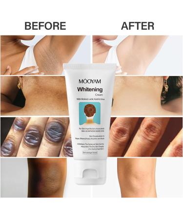 Skin Whitening Cream With Retinol Body Intimate Area Underarms Arms Knees Elbows Nourishing & Lightning Body & Neck Cream Natural Dark Spot Corrector for Private Parts(50g) - Buy Online on GoSupps.com