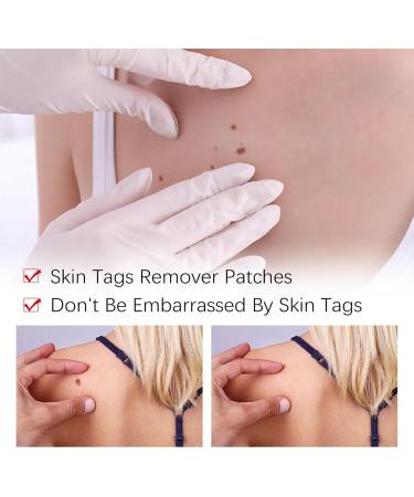 Anti Wart - Anti Wart Pen - Pen To Remove Mole - Anti Skin Tag Pen - Pen To Remove Skin Tags Remove Skin Tags - Buy Online on GoSupps.com