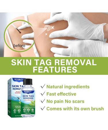 Skin Tag Removal Remover Kit Wart and Mole Remover Verruca Treatment for Hands Face Adults at Home 30ML - Buy Online on GoSupps.com