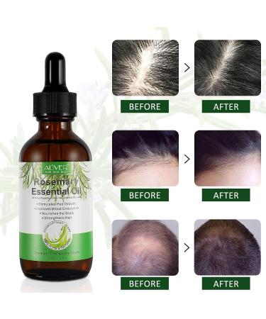 Rosemary Hair Growth Oil | Hair Loss Treatment | Stimulates Growth, Strengthens & Nourishes Scalp | For Men & Women | 2.02 Oz - Buy Online on GoSupps.com