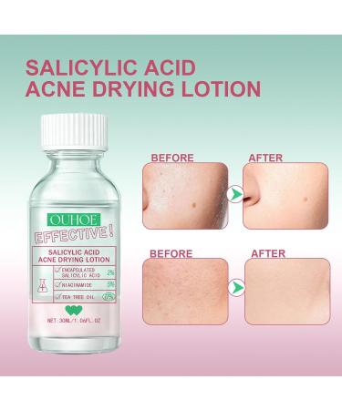Salicylic Acid Acne Drying Lotion - Acne Treatment - Overnight Drying Lotion for Spot Treatment - Blackhead Remover - Acne Spot Remover for Face - Anti Acne Face Serum - Pimple Lotion for Redness - Buy Online on GoSupps.com