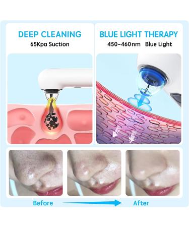 HD Blackhead Remover Pore Vacuum with Camera | Rechargeable Facial Cleaner for Women/Men | 4 Tips Included - Buy Online on GoSupps.com