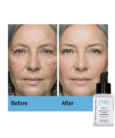 SkinCyclopedia Facial Serum Treatment Set Hyaluronic Acid Vitamin B5 + Hydrating Complex Anti Aging Deep Hydrator Wrinkle & Fine Line Reduction Bumpy Texture Repair Collagen Booster - Buy Online on GoSupps.com