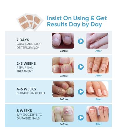 32Pcs Toenail Fungus Treatment Patches - Extra Strength Nail Repair Treatment for Discolored Nails - 32 Count - Buy Online on GoSupps.com