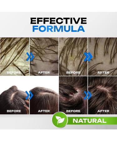 Exfoliating Shampoo for Healthy Scalp, Dandruff Removal, Greasy Hair Control, Volume Boost, and Hair Growth Promotion - 300ml - Buy Online on GoSupps.com